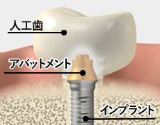 インプラントの構造