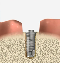 インプラント体を埋入し、骨との結合を待つ