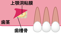 歯肉と骨を除去