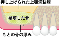 人工骨の充填