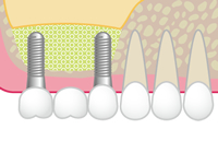 インプラントの埋入