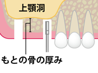 インプラントを埋入するための穴を形成