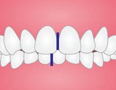 噛み合わせが悪く、下顎がずれている状態