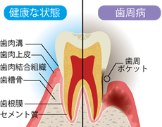 健康な状態と歯周病の違い