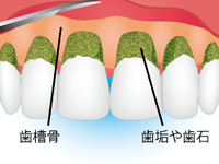 歯肉を切開