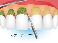 歯垢や歯石を除去