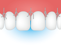 歯肉の縫合